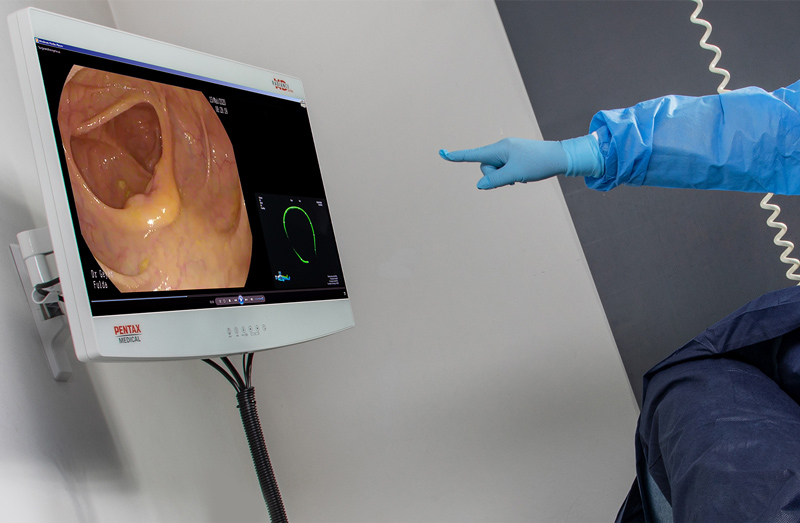 Auf einem Monitor ist das Untersuchungsbild einer Darmspiegelung zu sehen und ein Arm deutet darauf